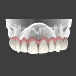 implantologia a carico immediato brindisi san pietro vernotico