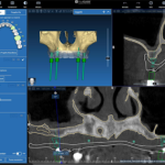 implantologia computer guidata brindisi