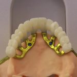 implantologia subperiostale brindisi