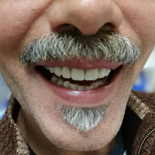 carico immediato dental day