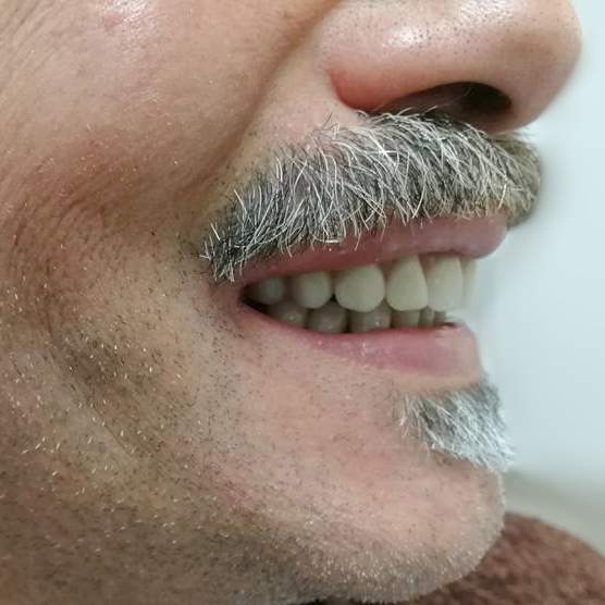 dental day carico immediato