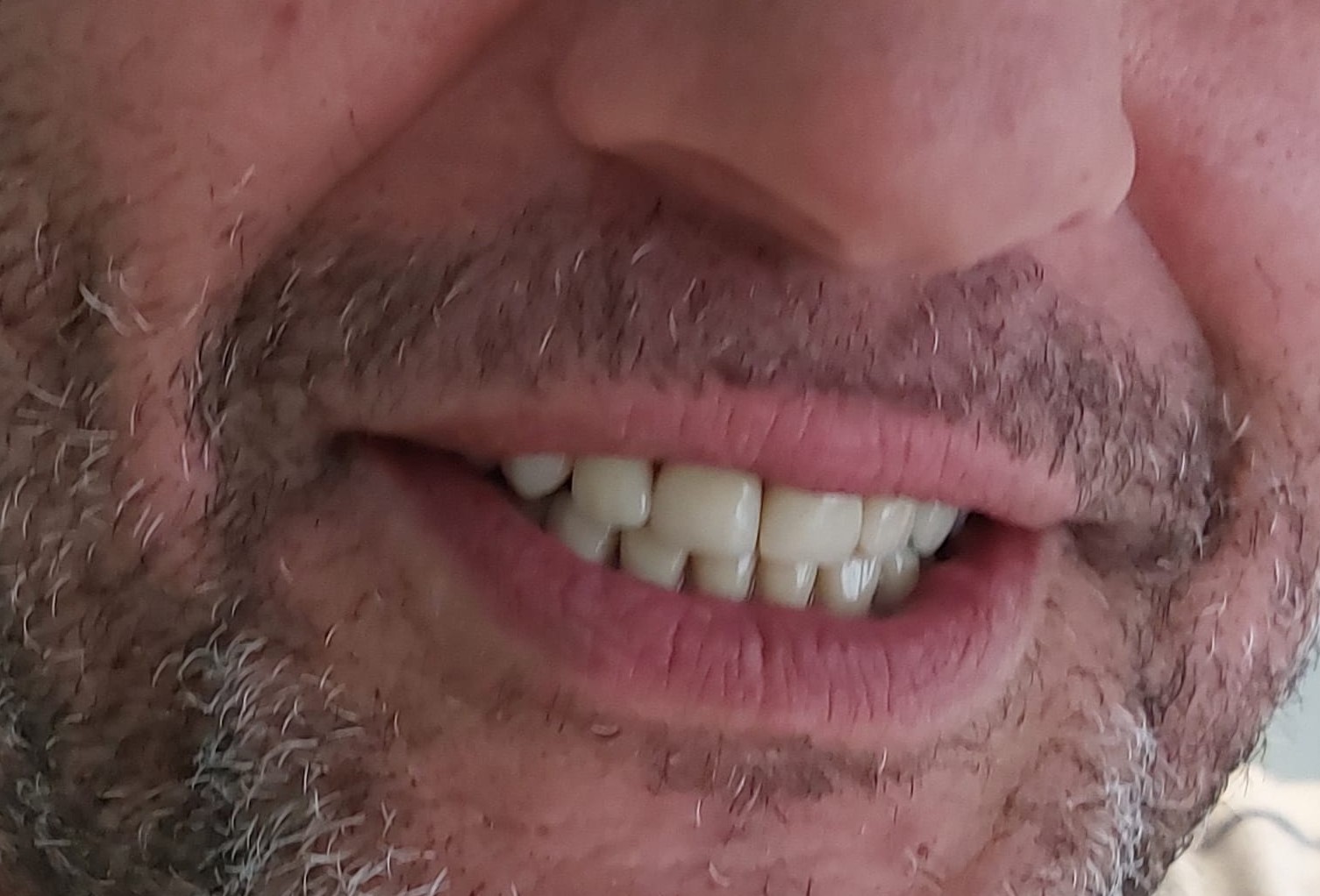 carico immediato san pietro vernotico