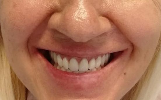 protesi fissa dental day